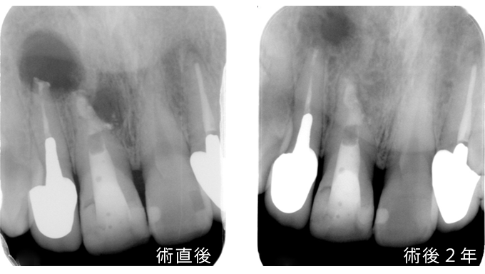 日本歯科保存学会専門医による精密根管治療 
