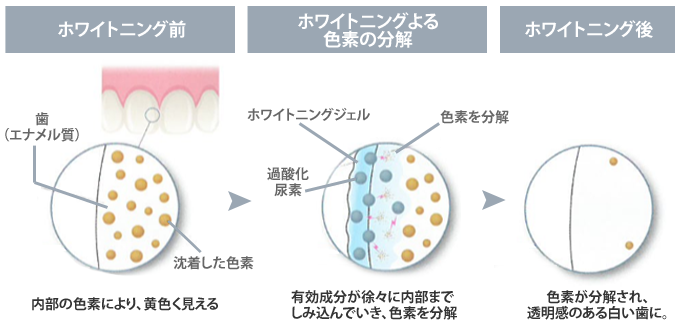 ホームホワイトニングについて