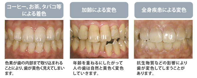 ホームホワイトニングについて