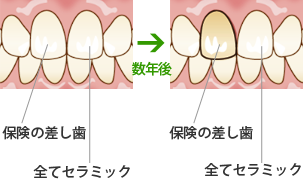ホームホワイトニングについて
