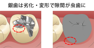 ホームホワイトニングについて