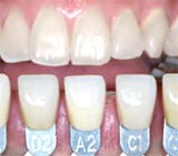 ホームホワイトニングについて