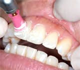 ホームホワイトニングについて